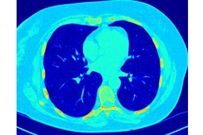 La comptition Data Science Bowl organise par linstitut national du cancer US et Kaggle a permis de distinguer les meilleurs projets algorithmiques de dtection des cancers du poumon. (crdit : D.R.)