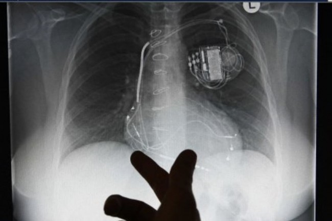 745 000 pacemakers fabriqués par Abbott doivent faire l'objet d'une mise à jour de leur firmware. (crédit : D.R.)
