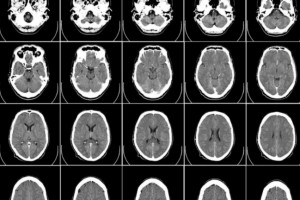Telex: Le CH de M�con cyberattaqu�, 100 000 scans de cerveaux cr��s par l'IA , Les CEO de Samsung et d'Intel discutent